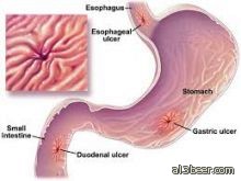 نصائح لمريض القرحة الهضمية في رمضان
